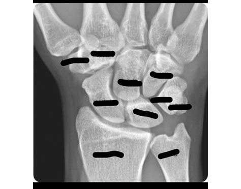 Wrist X ray Quiz