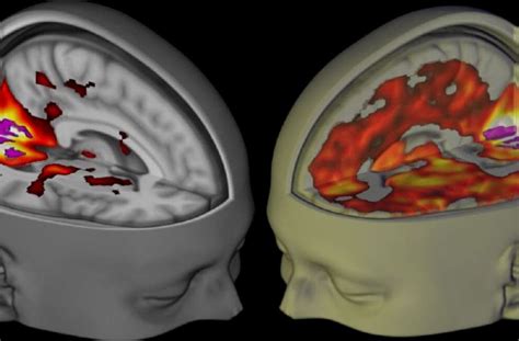 This Is What S Going On In The Brain During An LSD Hallucination