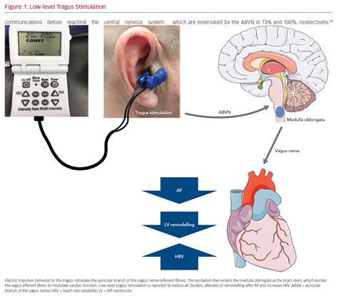 Vagus Nerve Stimulation Side Effects