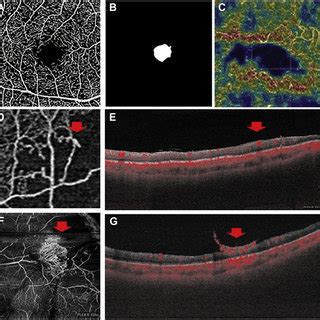 Consensus Oct Angiography Octa Parameters That Should Be Considered