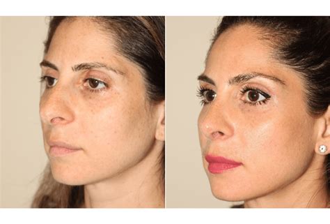 Rhinoplasty Dr Denton