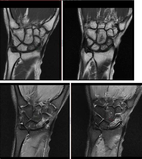 Occult fracture in the scaphoid and bone bruise of the capitate shown ...