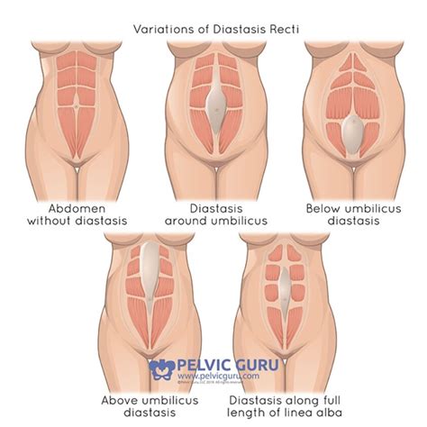 What Is Diastasis Recti And How Do I Know If I Have It Bud Bloom