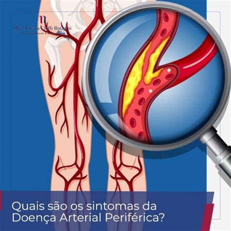 Quais São Os Sintomas Da Doença Arterial Periférica