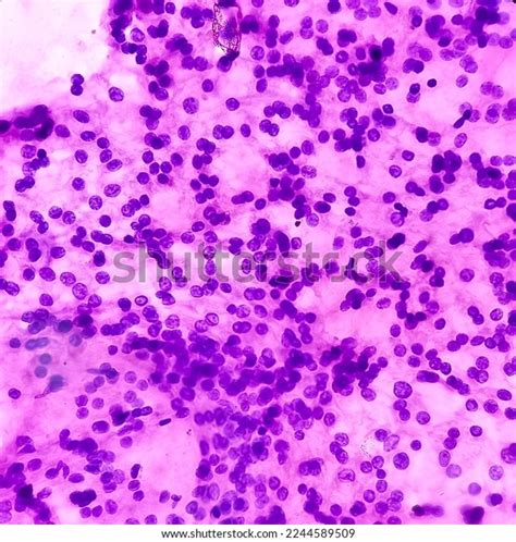 Thyroid Nodule Fna Cytology Cellular Follicular Stock Photo 2244589509 ...