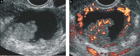 Ovarian Cancer Arising In Endometrioid Cysts Ultrasound Findings