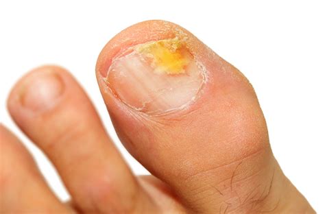 6 Tips To Stop Nail Fungus Before It Starts | | BlackDoctor