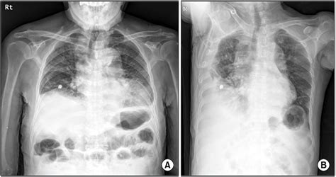 Chest Radiograph Upon Admission A It Shows Diffuse Ground Glass Download Scientific Diagram