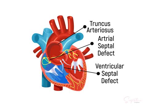 Figure This Image Illustrates Atrial Septal StatPearls NCBI