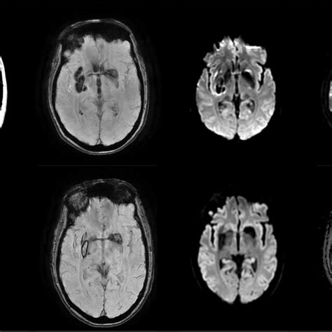 A Initial And B 7 Month Follow Up Magnetic Resonance Images