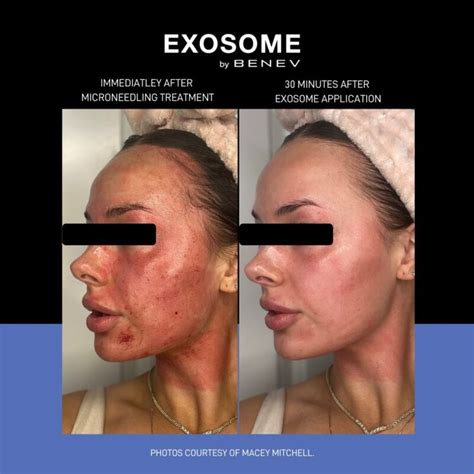 Exosome Therapy Garza Plastic Surgery In Nashville