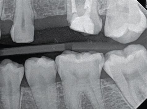 Postoperative Intraoral Radiographs Intraoral Periapical Radiograph Of