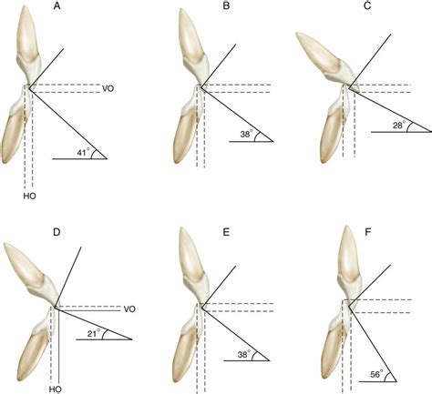 6 Determinants Of Occlusal Morphology Pocket Dentistry