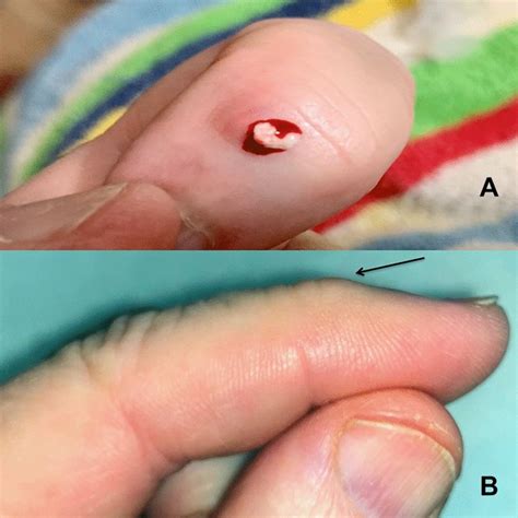 Expression Of Cyst Contents And Resolution Of Cyst A After Needling