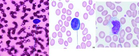 A Atypical Lymphocyte With Plasmacytoid Features Small Cell With Download Scientific Diagram