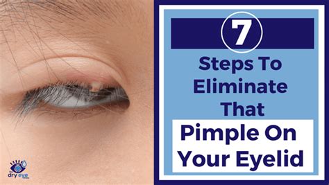 7 Steps To Eliminate That Pimple On Your Eyelid (also known as a Stye) - Eye Love