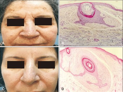 A Multiple Skin Colored Papules On The Face B D Follicle Download Scientific Diagram