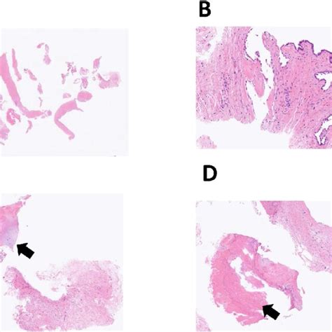 Pathological Findings Of A Biopsy Sample A Macroscopic Findings B