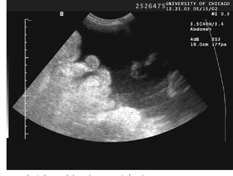 Figure From Embolization Iatrogenic Hemorrhage After Paracentesis