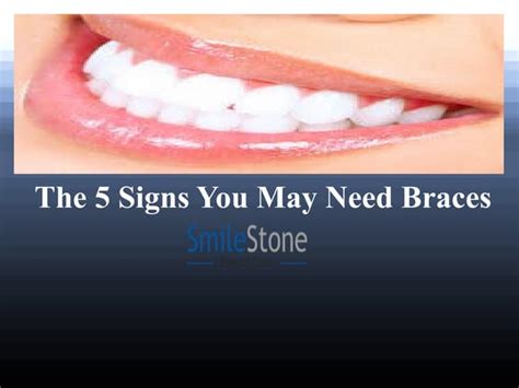 The 5 Signs You May Need Braces