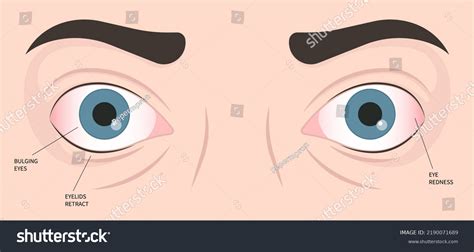 Hashimotos Thyroiditis Graves Disease Eye Swollen Stock Vector Royalty Free 2190071689