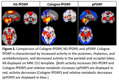 Parkinsons Disease Related Pattern Using Resting State Functional Mri Validation And