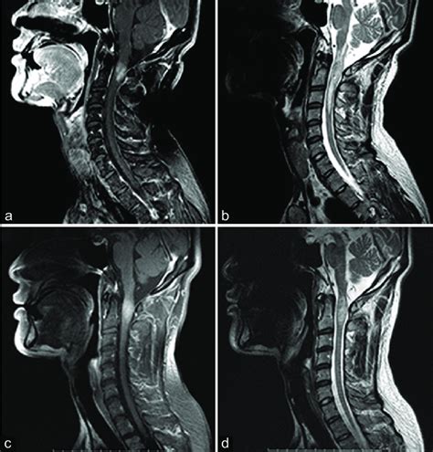 A Sagittal T1 Weighted Postgadolinium Magnetic Resonance Mr Images