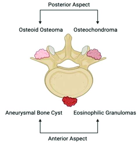 Illustrative depiction of the anatomical location of common primary ...