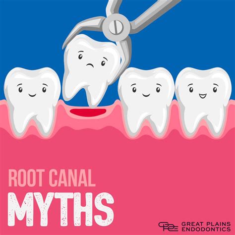 Great - Root canal myth: It's better to pull a tooth than have root
