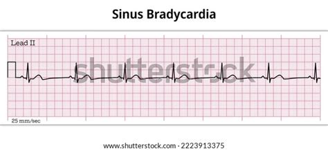 Ecg Sinus Bradycardia 8 Second Ecg Stock Vector (Royalty Free ...