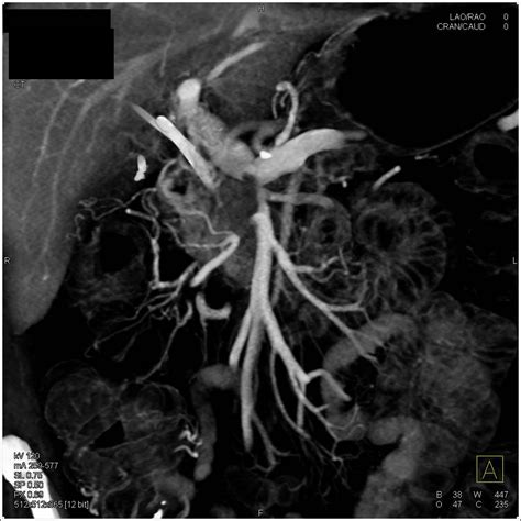 Pancreatic Cancer Encases Pv Smv Junction With Collaterals Pancreas