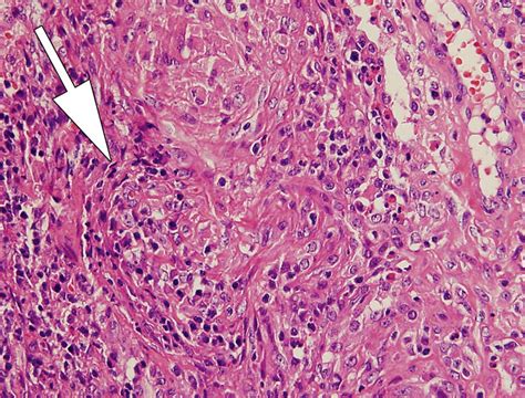 Eosinophilic Lung Diseases A Clinical Radiologic And Pathologic