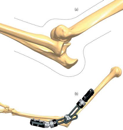 Elbow Fracture Or Dislocation Treatments Orthofix Abs