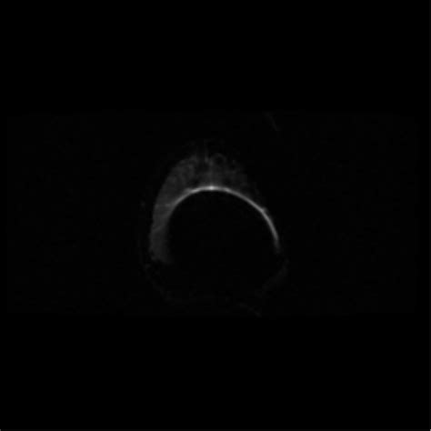 Choroid Plexus Papilloma Radiopaedia Axial Dwi Nc Commons