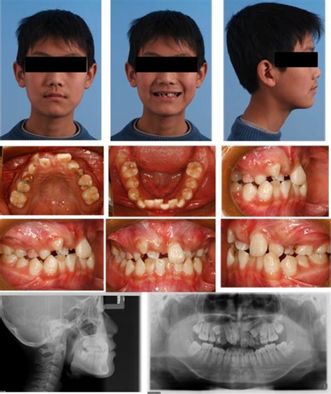 Orthodontic Management With Traction And Asymmetric Extraction For