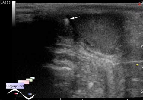 Scrotum Pearls Scrotum Sonography Clinical Report Video Images