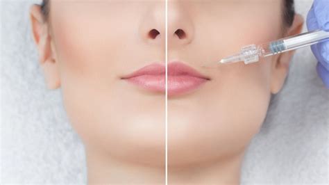 Preenchimento Labial Antes E Depois 1 Ml Cultura Notícias