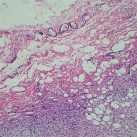 (PDF) Gorham’s disease of Femur