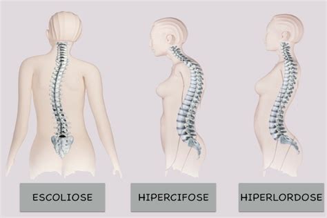 Hiperlordose O Que É - Hiperlordose: o que é, tipos, sintomas e tratamento | Cifose ...