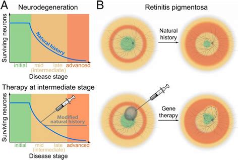 Retinitis Pigmentosa: Top 8 Natural Treatment