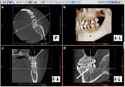 CBCT: Imaging Beyond Dental X-Rays | ITS Dental Hospital