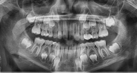 Pano Bite Size Pediatric Dentistry