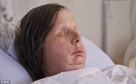 Carla Nash Face Transplant Pictures Chimp Attack Victim Reveals Her