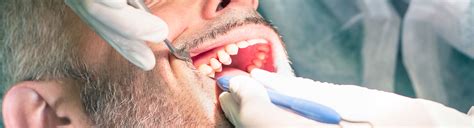 full mouth debridement family dental practice