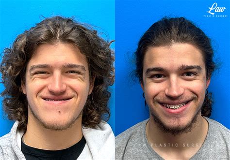 Jaw Surgery Before And After Photos Law Plastic Surgery