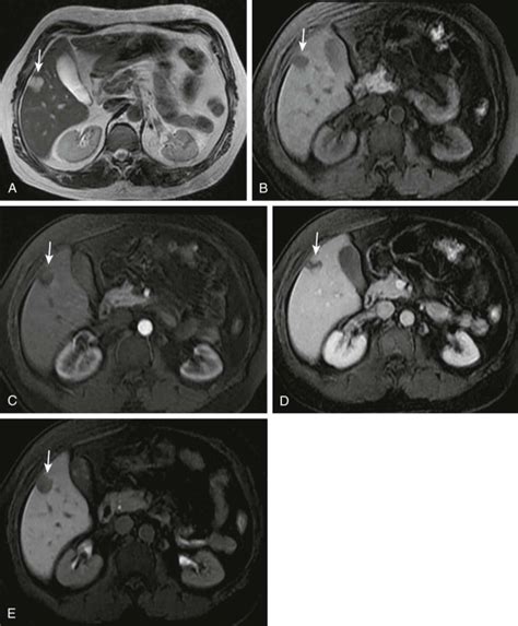 Benign Tumors Of The Liver Radiology Key