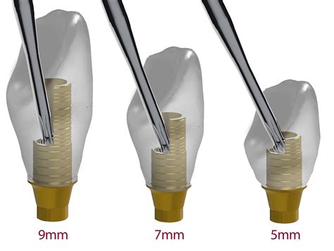 Dynamic 3tibase® Dynamic Abutment Solutions En