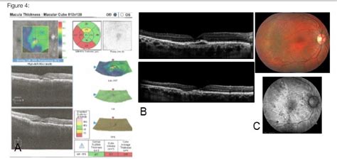 Figure 4 from Update on Central Serous Chorioretinopathy Atualização em