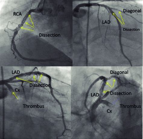 Figure Coronary Angiography Demonstrated Spiral Dissections In Rca