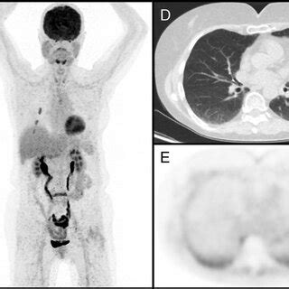 Comparison Of 18 F FDG PET CT A C And 68 Ga FAPI 46 PET CT D F The